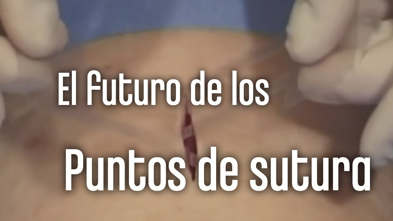 los puntos de aproximación se caen solos